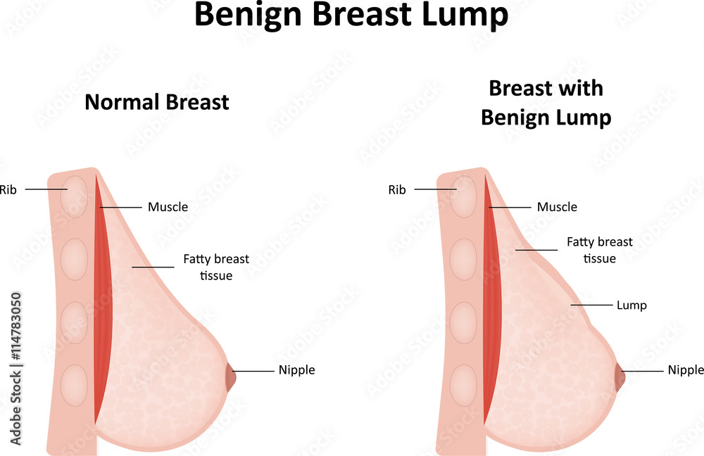 best benign breast clinic in thane