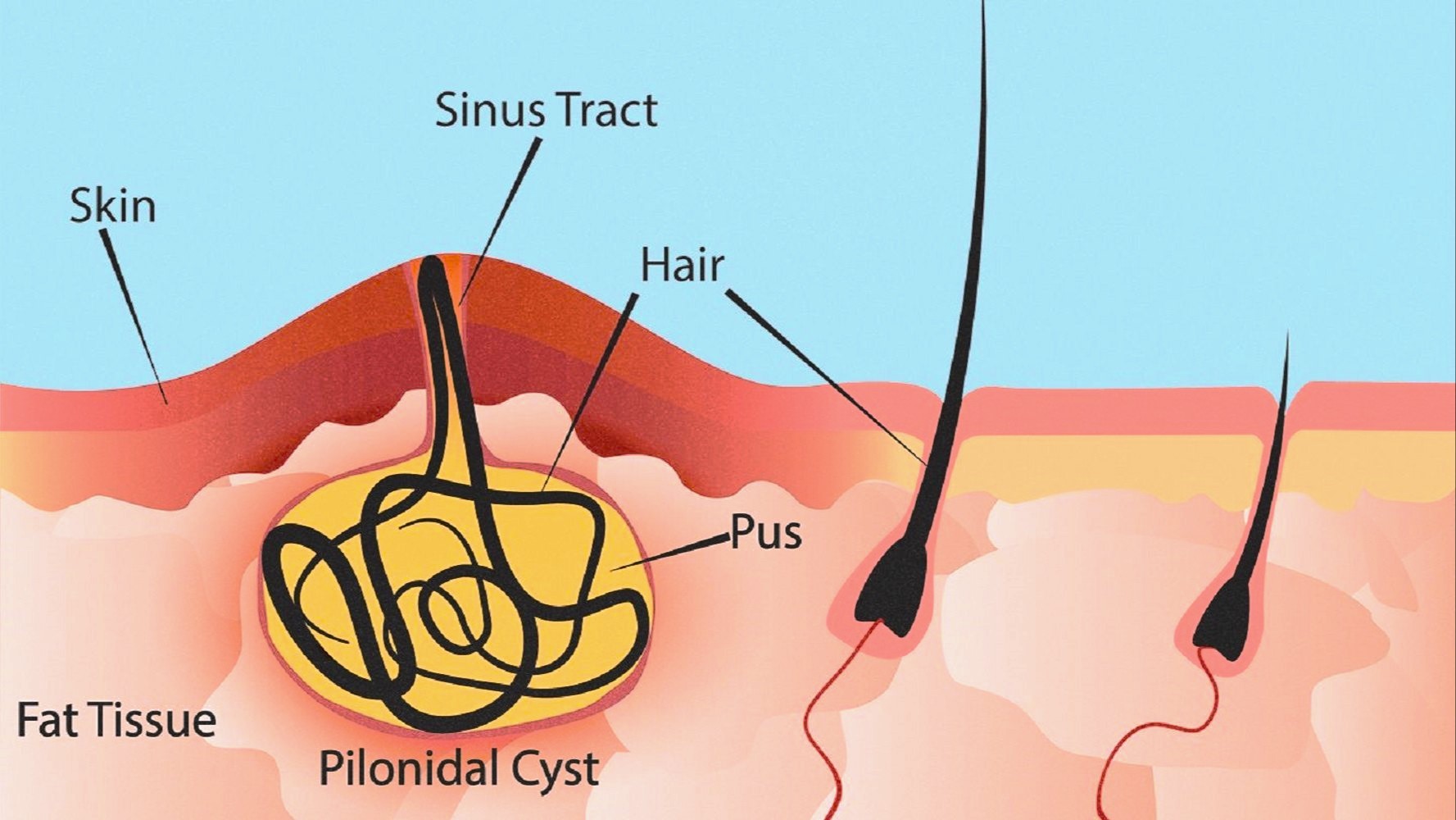 Best Endoscopic And Laser Treatment For Pilonidal Sinus in Mumbai