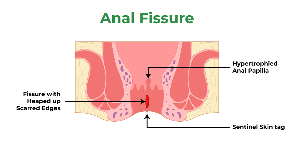 Best Laser Treatment For Anal Fissure in Thane